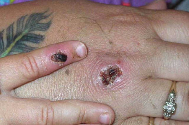 <p>The hand of a patient with the rare infection monkeypox </p>