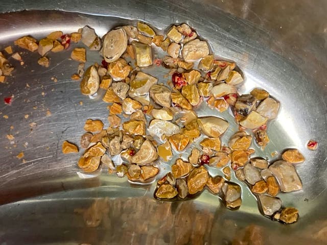 <p>Kidney stones (pictured) are a painful health condition </p>