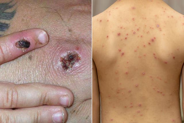 <p>Symptoms of the monkeypox virus (left), and someone suffering from chickenpox (right) </p>