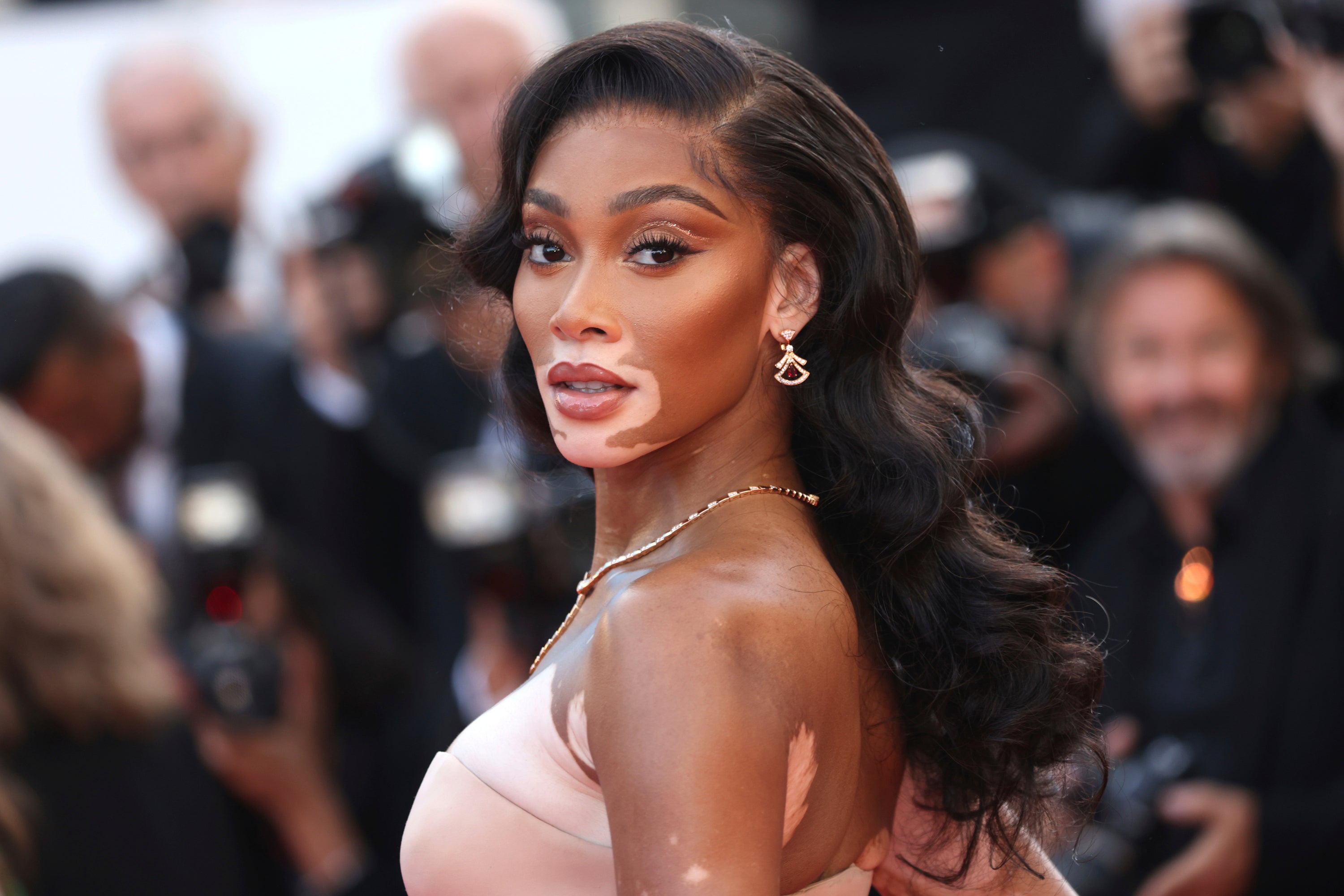 Winnie Harlow is one of the most prominent stars with vitiligo