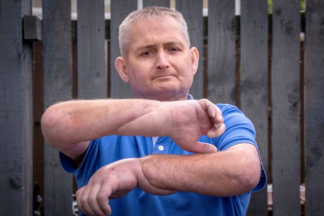 Steven Gallagher has had a double hand transplant (Jane Barlow/PA)