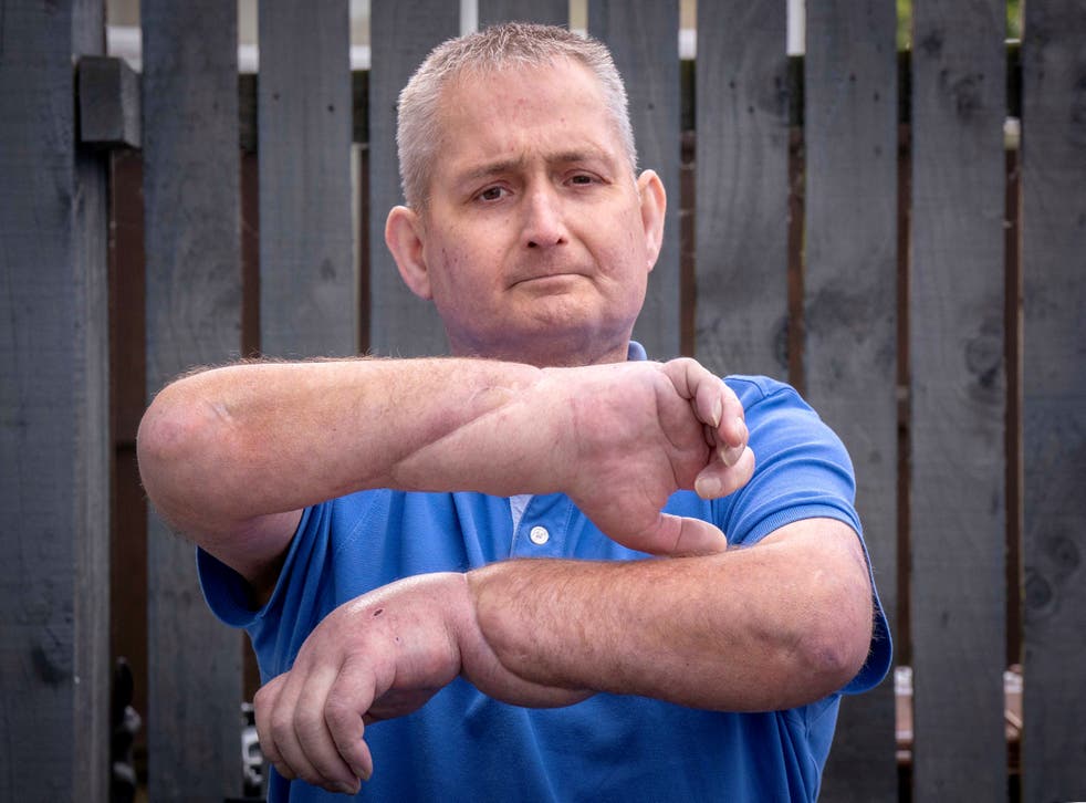 Steven Gallagher has had a double hand transplant (Jane Barlow/PA)