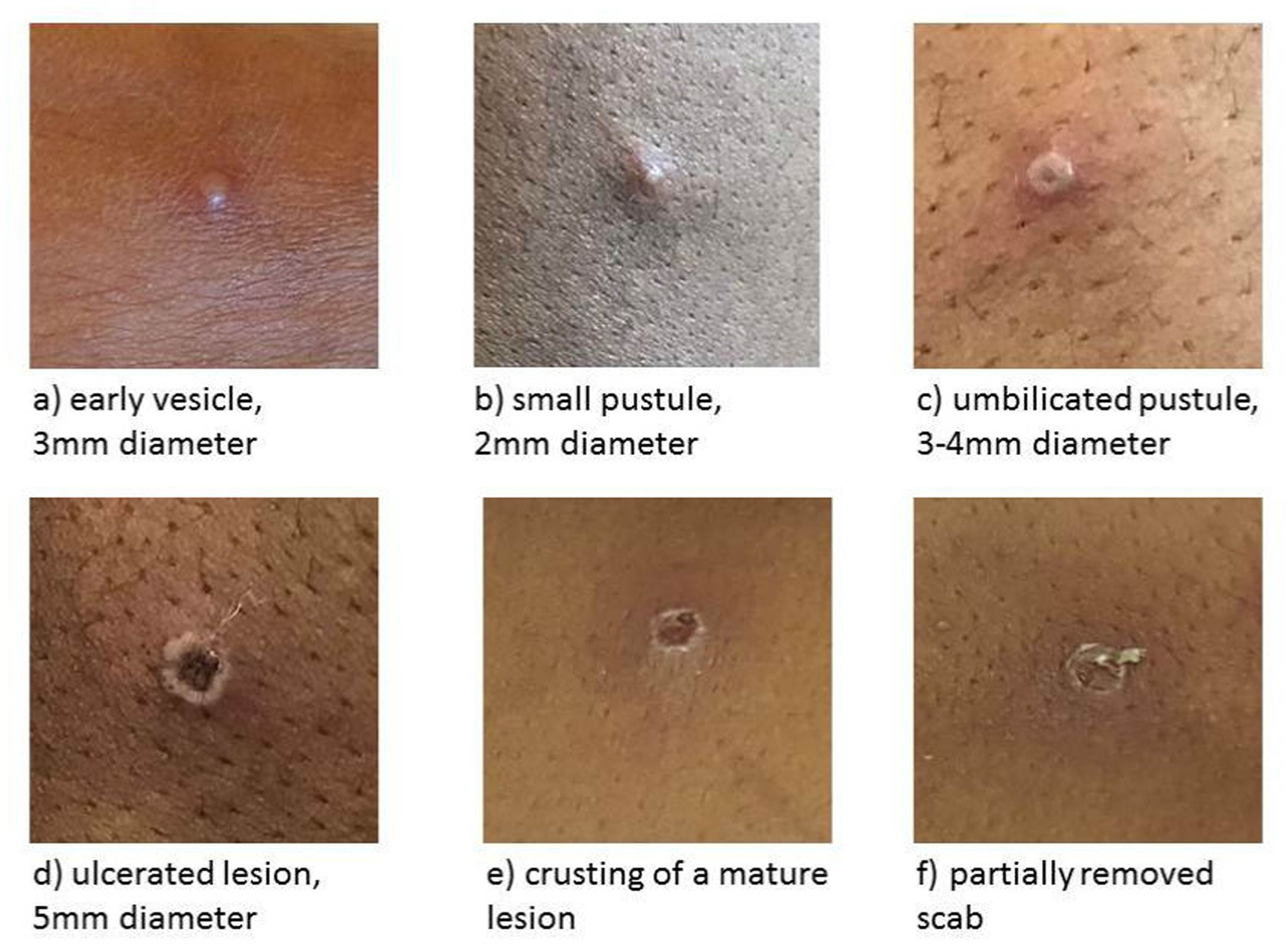 The condition results in blisters on the body, which then scab over)