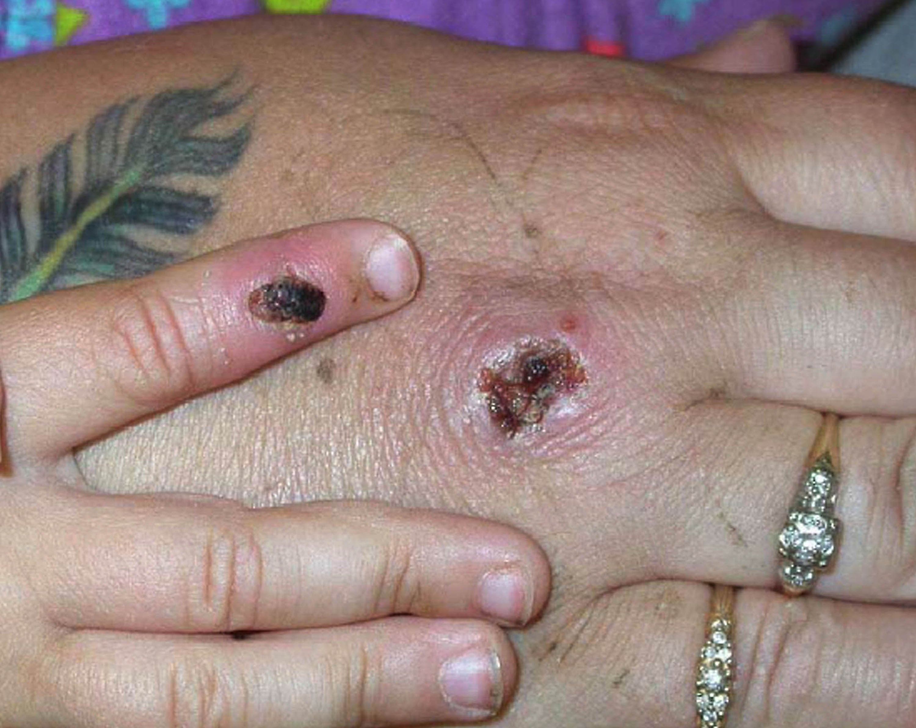 Symptoms of one of the first known cases of the monkeypox virus are shown on a patient’s hand in 2003