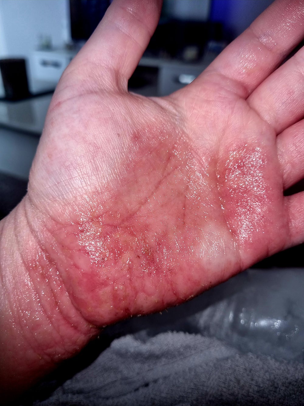 Kimberley’s hand raw and peeling earlier this year, in April 2022 (Collect/PA Real Life)