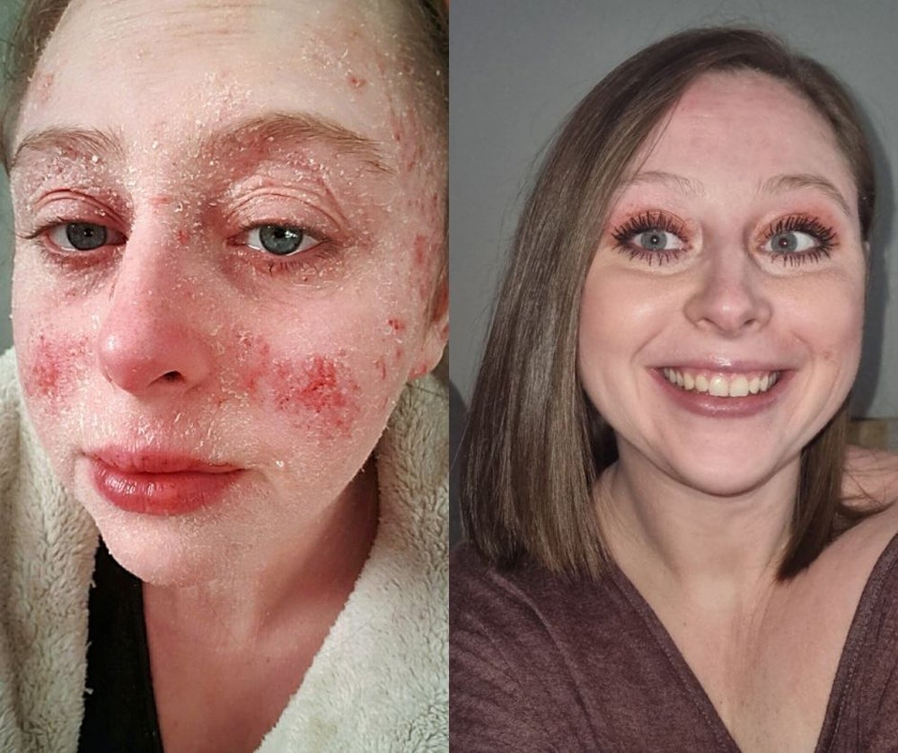 Kimberley Reardon, 30, in September 2020 compared to now, with clear skin (Collect/PA Real Life)