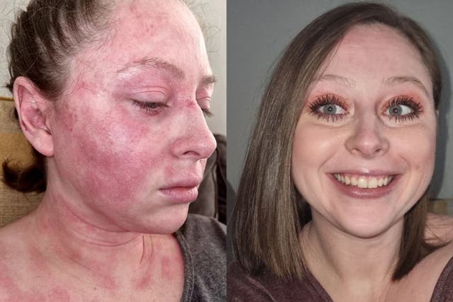 Kimberley Reardon, 30, in March 2020 compared to now, with clear skin (Collect/PA Real Life)