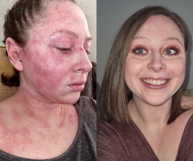 Kimberley Reardon, 30, en marzo de 2020 en comparación con ahora, con piel clara (Collect/PA Real Life)