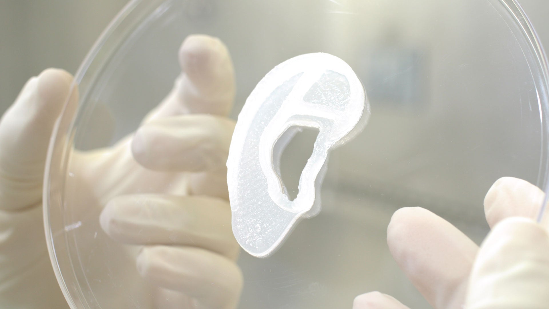 Surgeons perform human ear reconstruction surgery using 3D bioprinted living tissue implant