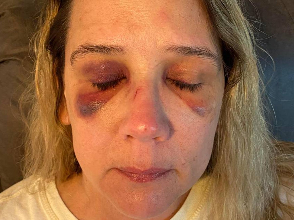 Mother reveals gruesome injuries after she says she was beaten by teen girls who wanted to fight her daughter