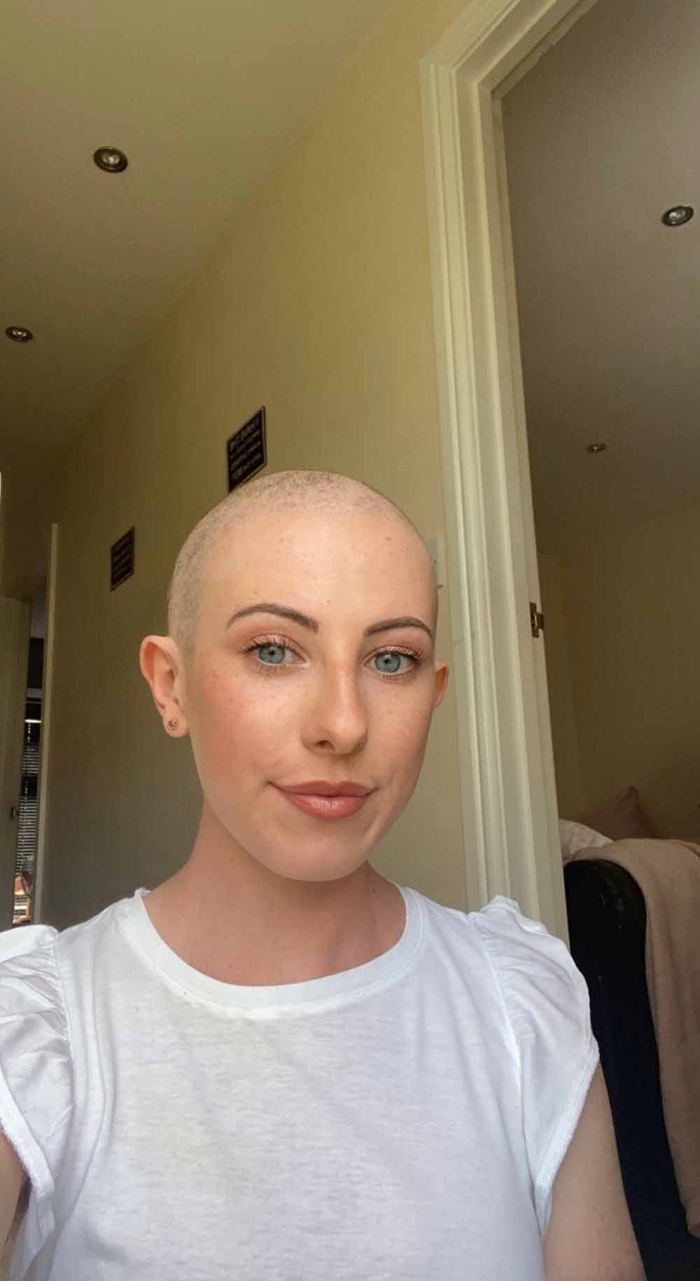 Siobhan lost her hair after her first round of chemo. (Collect/PA Real Life)