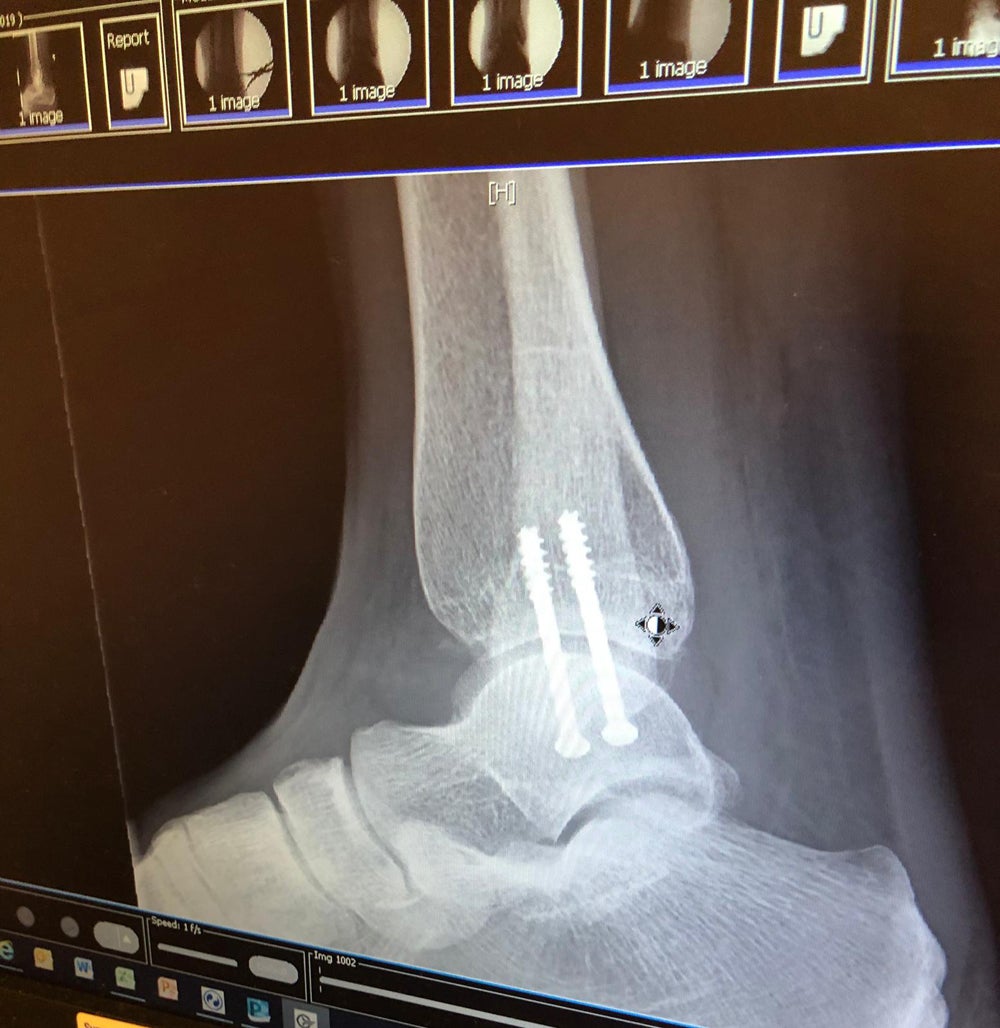 Kat’s ankle x-ray (Collect/PA Real Life)