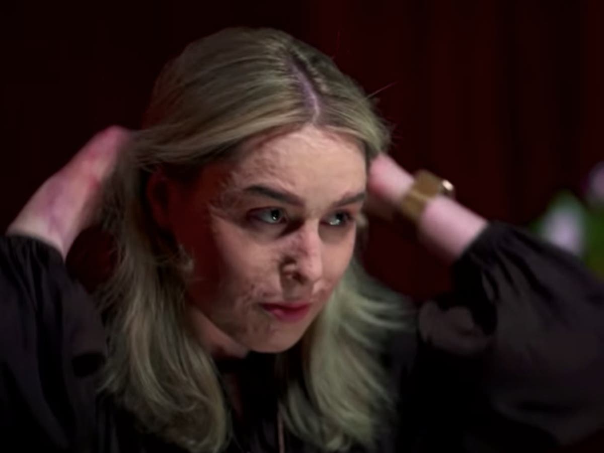 Australian woman who got third-degree burns from volcano eruption shows her face for first time Australian woman who got third-degree burns from volcano eruption shows her face for first time