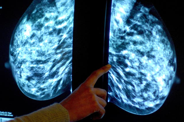 A new study suggests that some breast cancer patients can forgo radiotherapy (Rui Vieira/PA)