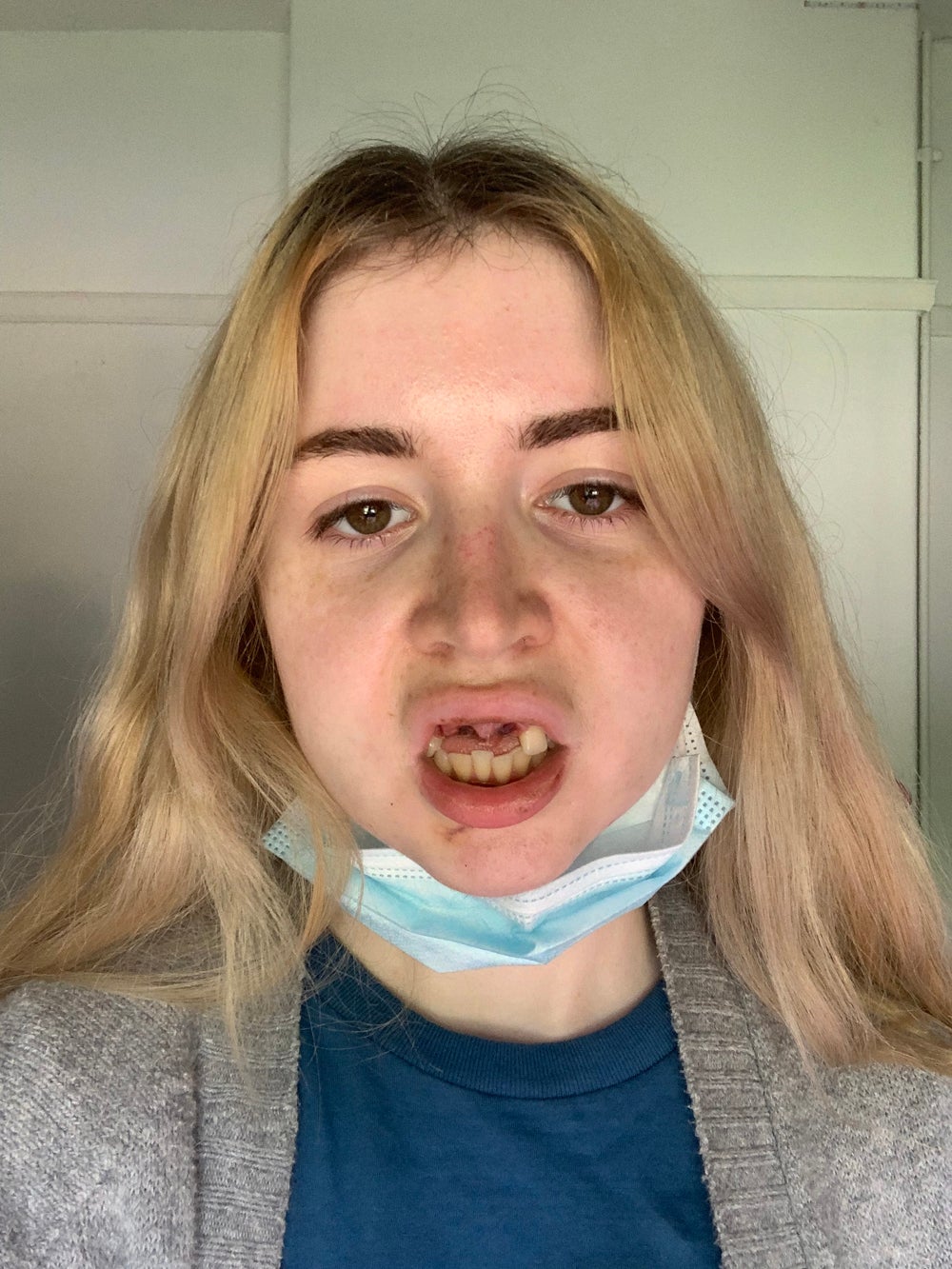 Georgina Rossiter, 24, has lost her three front teeth (Collect/PA Real Life)