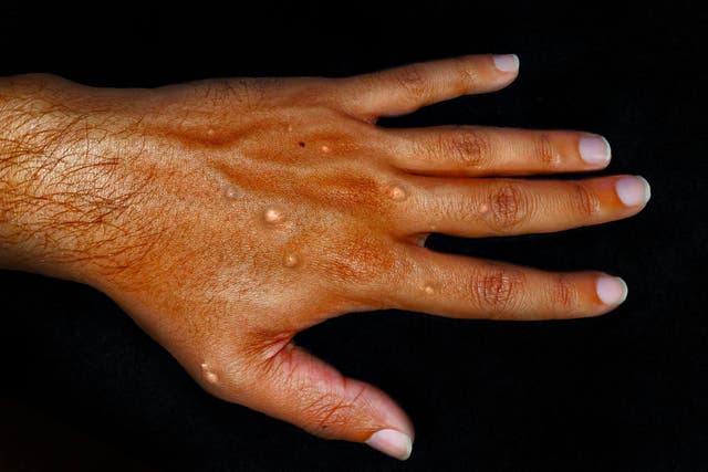 The UK Health Security Agency announced that it has detected 18 additional cases of monkeypox in England (Alamy/PA)