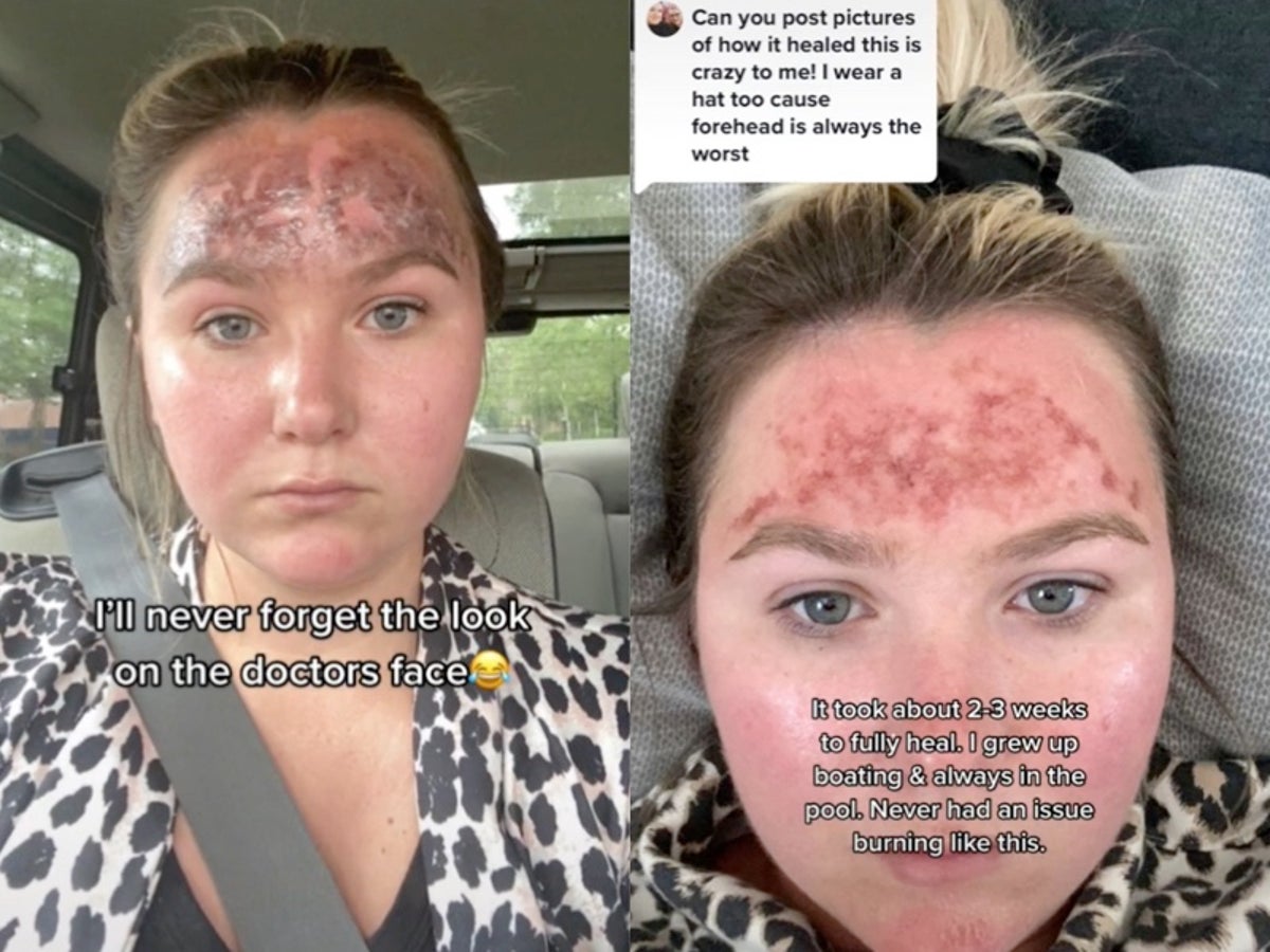 burned face before and after