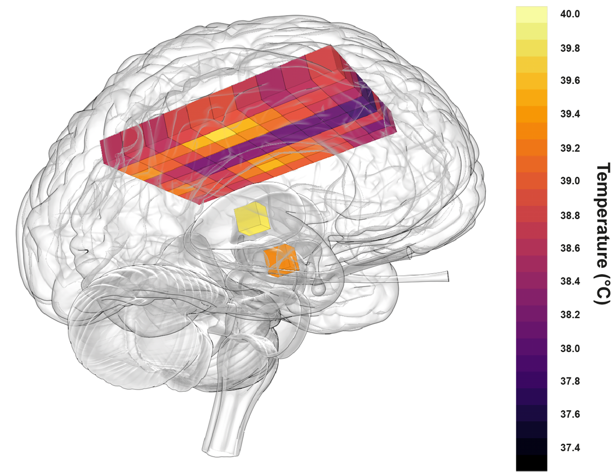 The temperature of the healthy human brain varies much more than