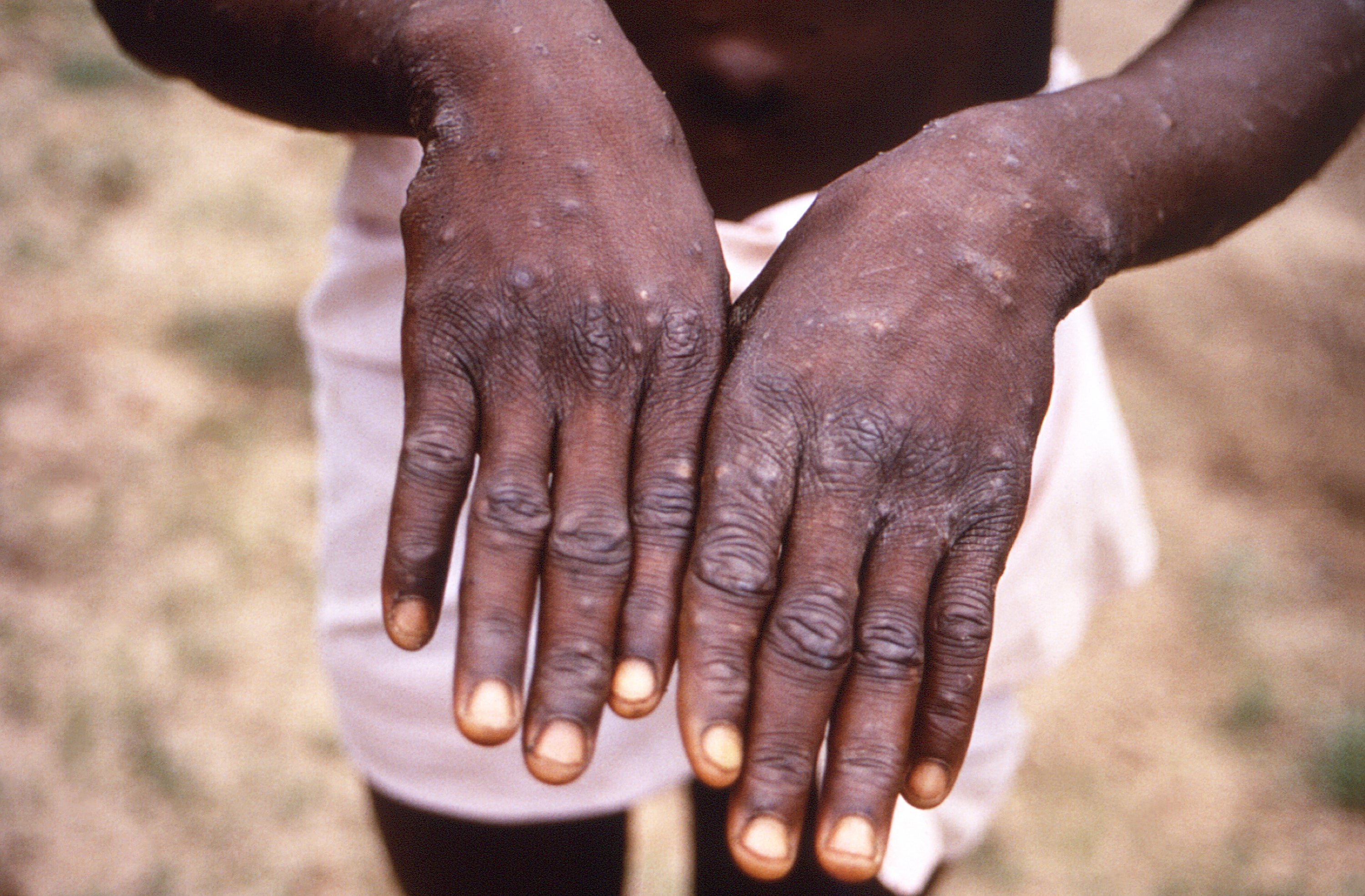 <p>Symptoms of monkeypox include a high temperature, headache, a rash, muscle aches, backache, swollen glands, shivering, and exhaustion</p>