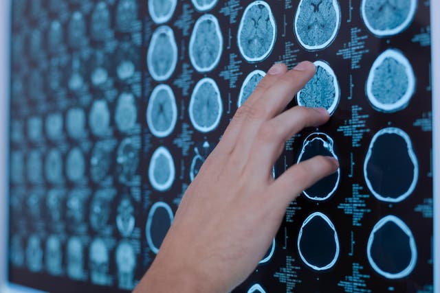 A new test could diagnose brain tumours much sooner, researchers hope (Alamy/PA)