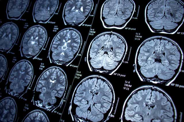 <p>MRI scans detect the presence of a particular substance in the brain by scanning for its unique chemical ‘signature’ </p>
