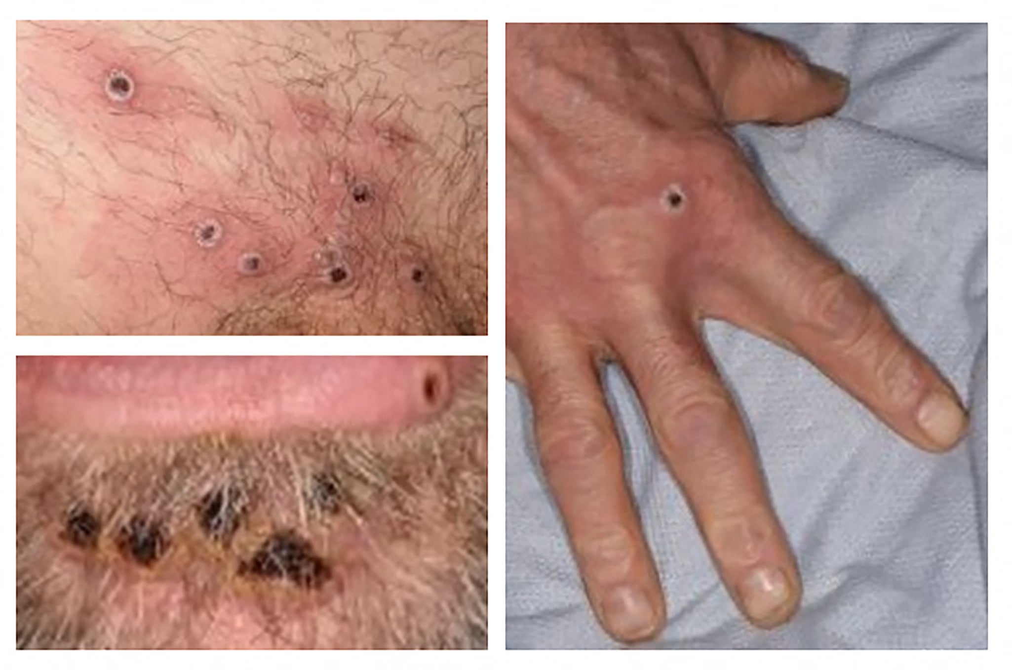 Signs of the monkeypox virus on a patient’s skin