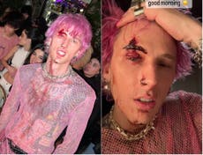 Machine Gun Kelly shares photos of gash on face after smashing glass on himself during performance
