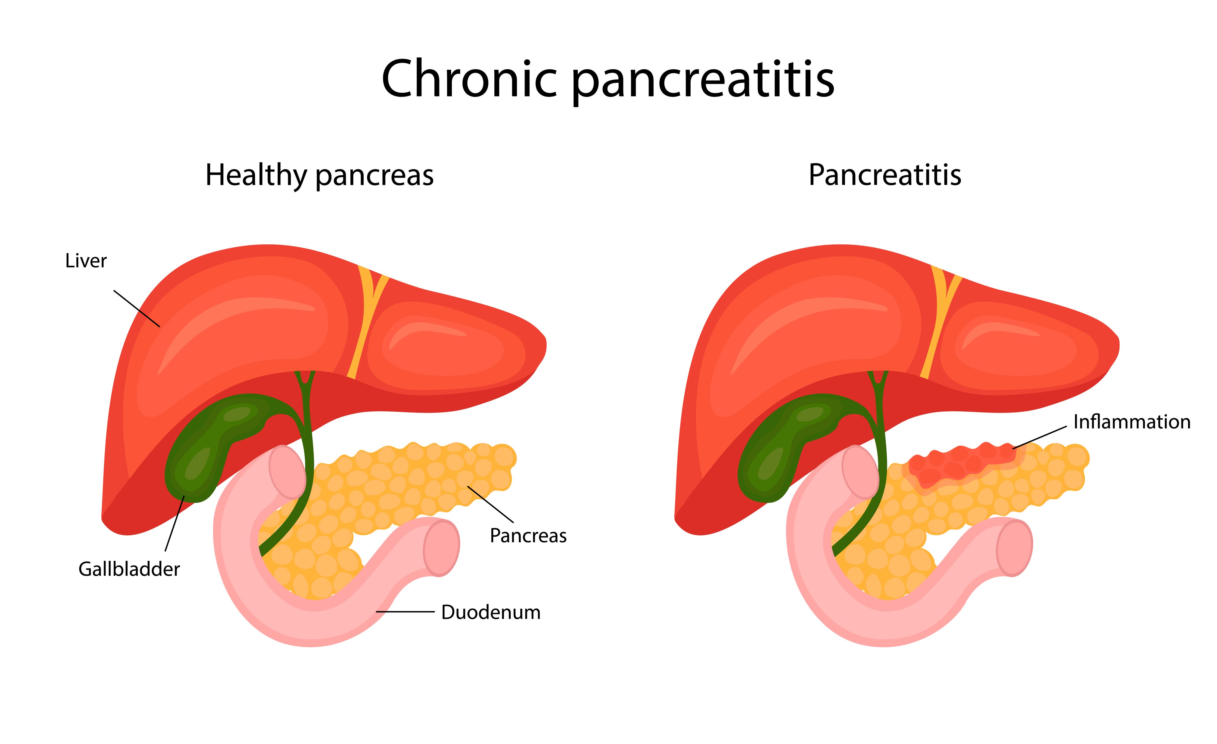 The difference between a healthy pancreas and an inflamed pancreas