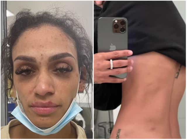 Mychelle Johnson, esposa de Miles Bridges, publicó imágenes de sus heridas en las redes sociales