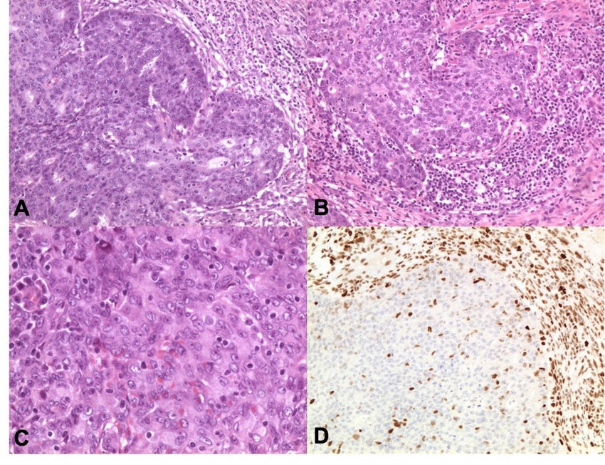 MMRd mutations can also make a tumour more vulnerable to the body’s immune system