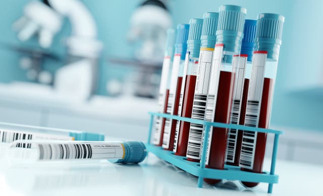 <p>Blood test for ME could show biomarkers for the condition</p>