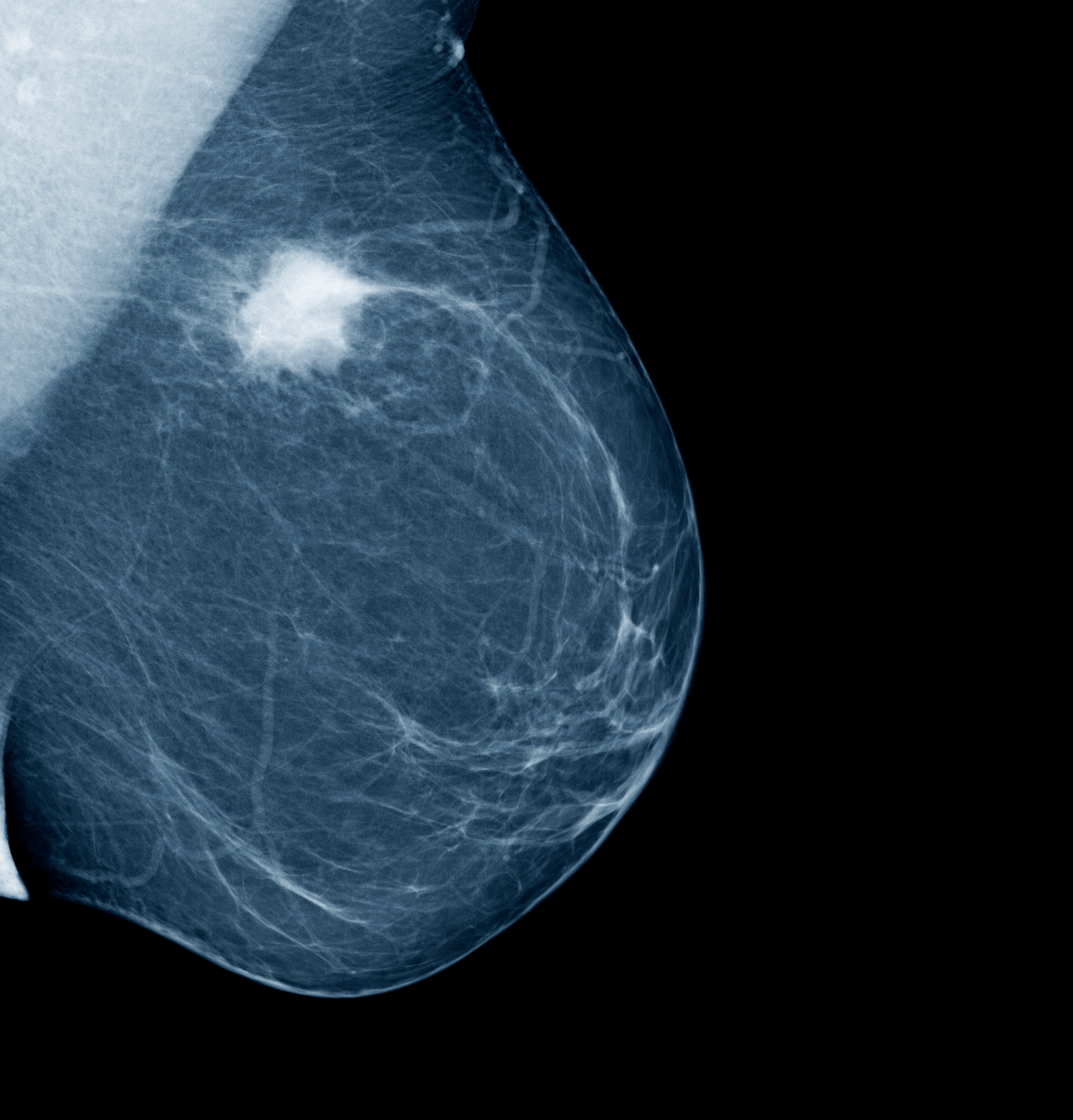 Survival rates for the likes of breast cancer are the highest they have ever been