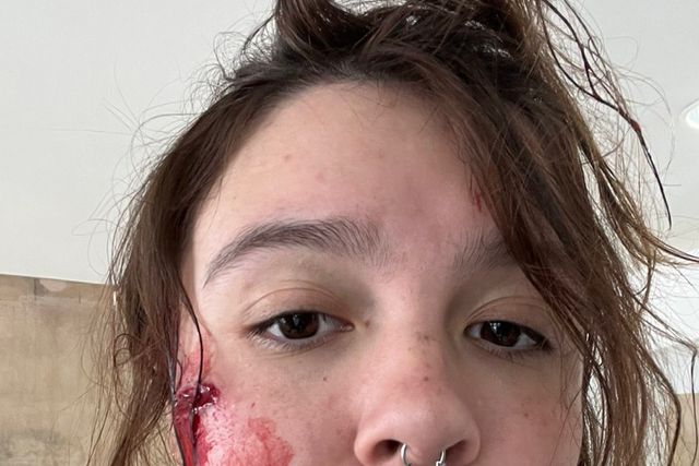 <p>A young woman known as Lilli shared photographs of the injuries she sustained in the Highland Park mass shooting</p>