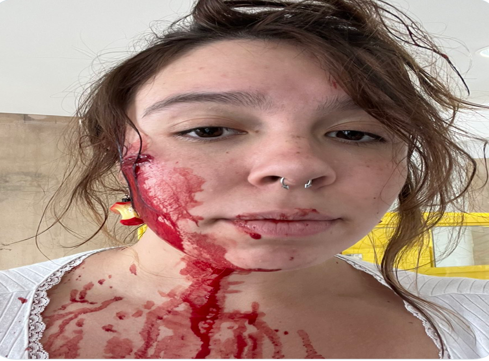 <p>A young woman known as Lilli shared photographs of her injuries sustained in the Highland Park mass shooting</p>