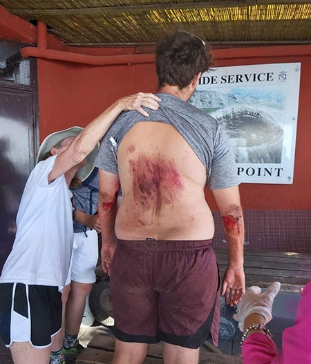 The tourist's injuries