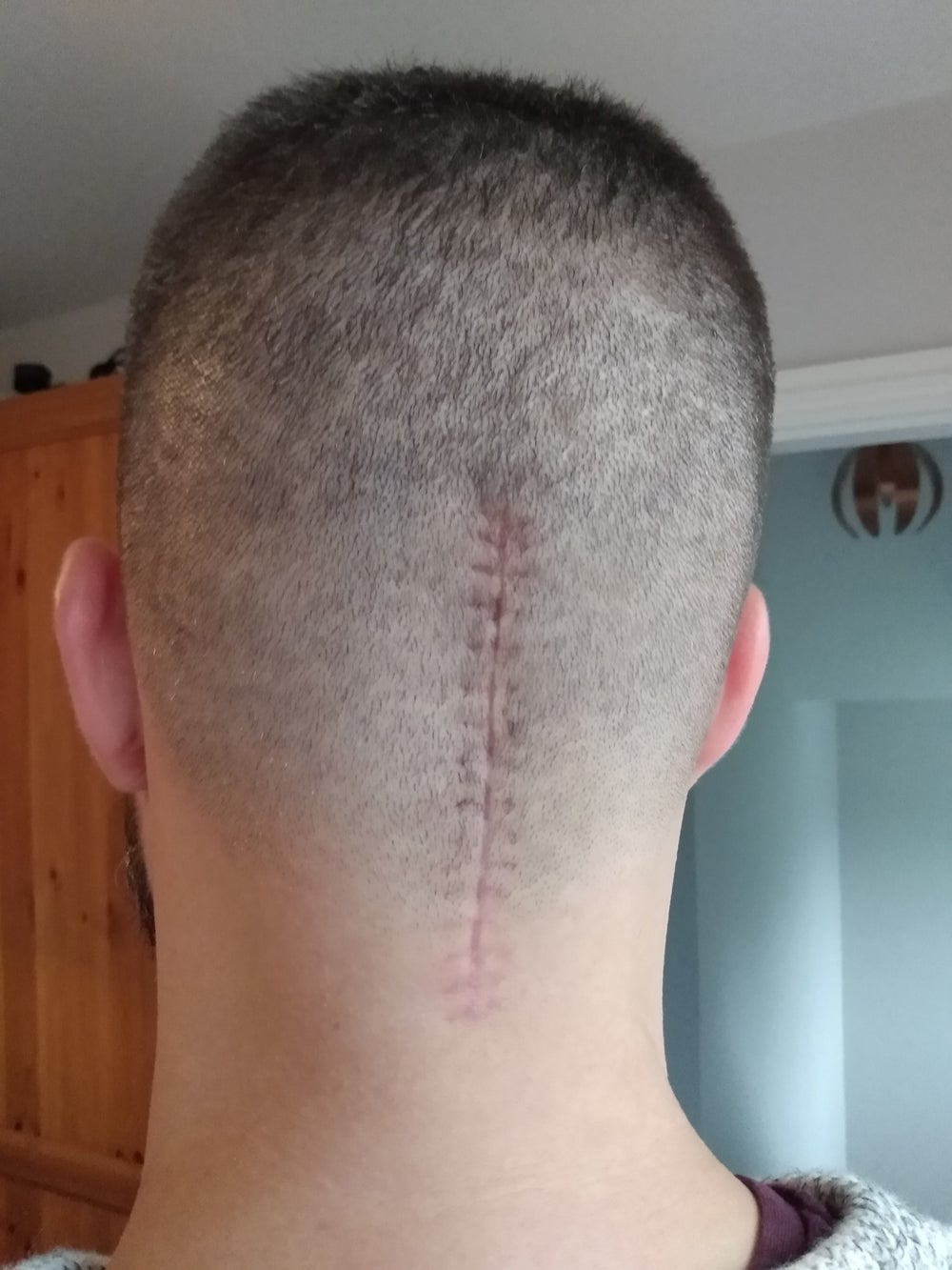 Ben Wilson, 36, with his scar healing (Collect/PA Real Life)