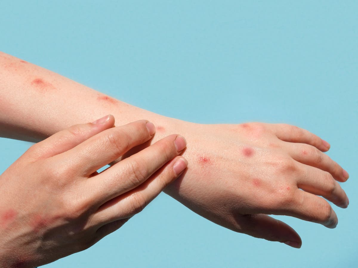 How to get a monkeypox vaccine as UK cases rise How to get a monkeypox vaccine as UK cases rise