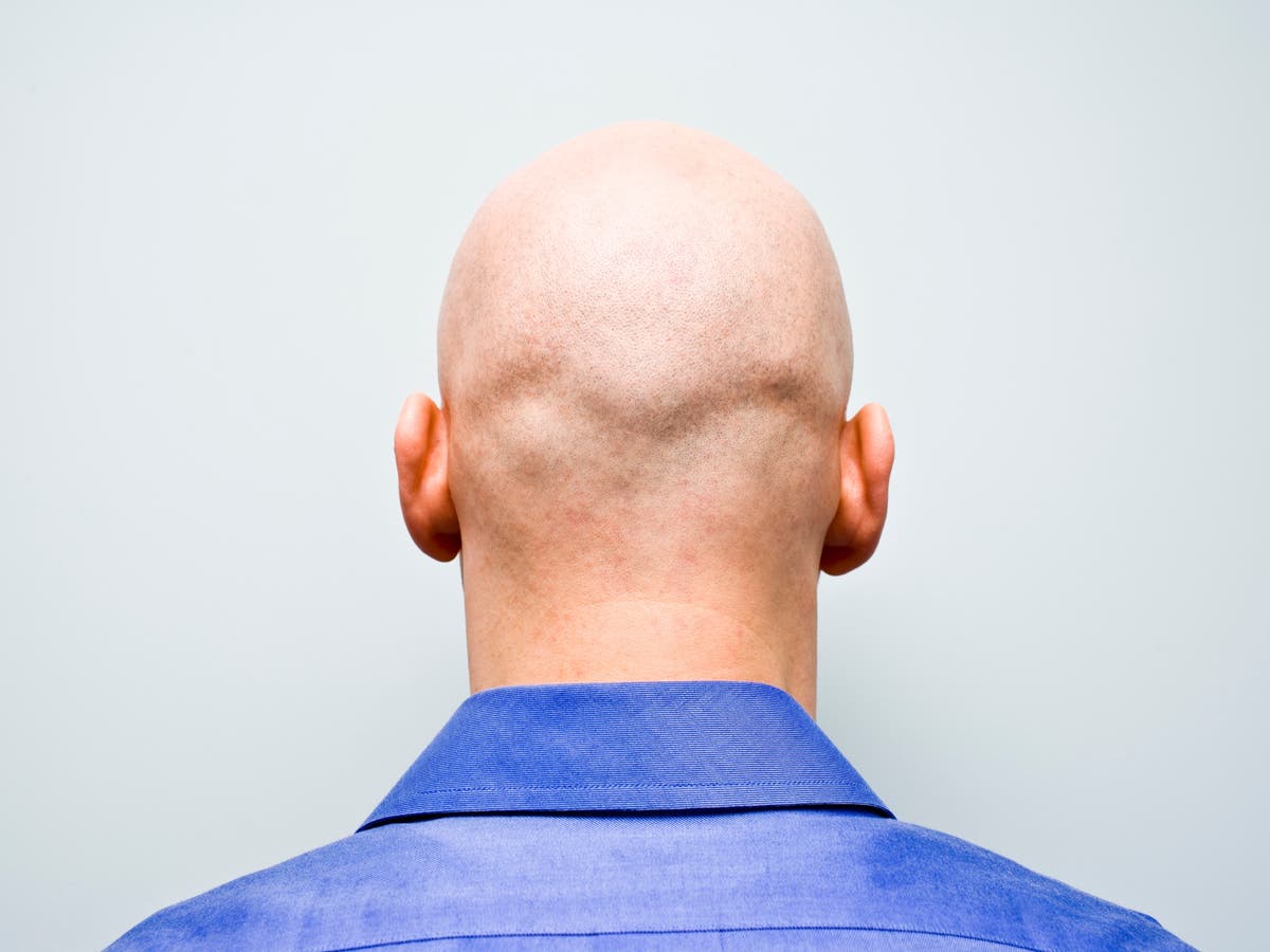 scientists-have-finally-found-the-potential-cure-for-baldness
