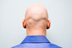 Scientists find potential ‘cure’ for baldness