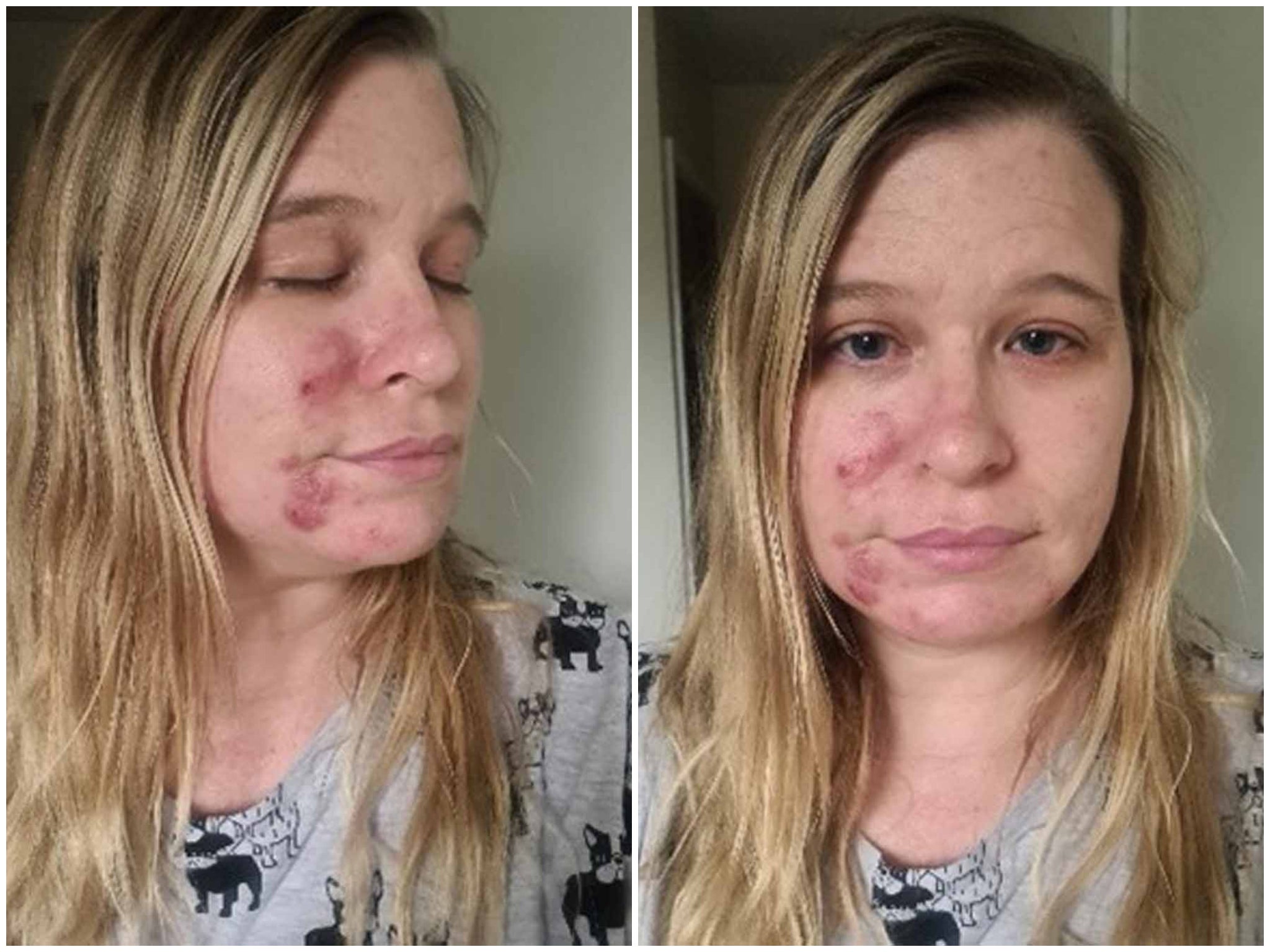 Woman hails £85 skincare kit as miracle cure for her cystic acne The Independent