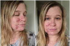Woman hails £85 skincare kit as ‘miracle cure’ for her cystic acne