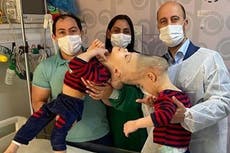 Conjoined twins whose brains were fused together separated by UK surgeon