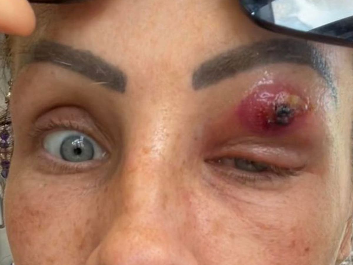 Mother feels pop as &lsquo;parasite&rsquo; crawls out of eyelid &lsquo;like scene from horror film&rsquo;