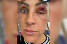 Mother feels pop as ‘parasite’ crawls out of eyelid ‘like scene from horror film’