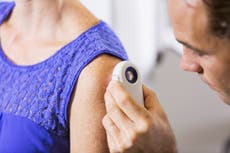 Warmer summers fuelled by climate change prompt skin cancer warning