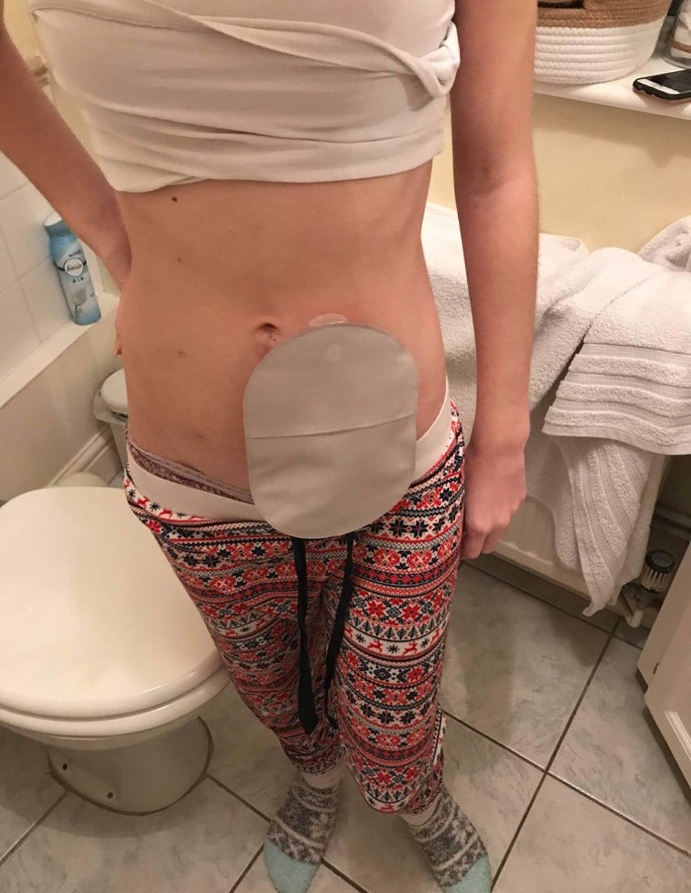 Sophie Anderson, 24, with her first colostomy bag (Collect/PA Real Life)