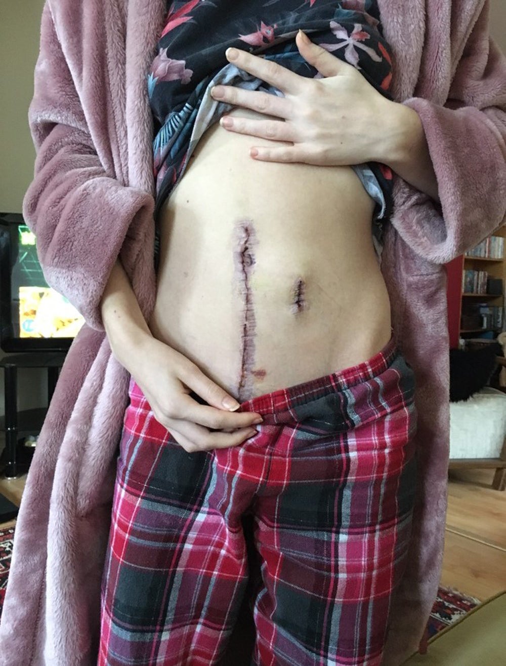 Sophie’s scar after her first big surgery (Collect/PA Real Life)