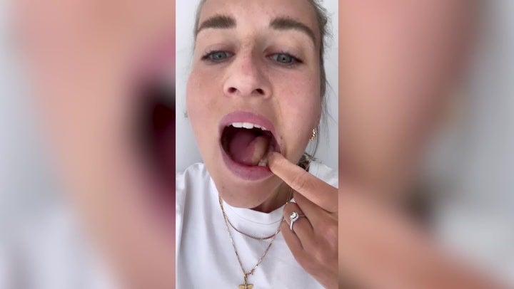 Womans tongue re-made from leg muscles after battling mouth cancer Lifestyle Independent TV image