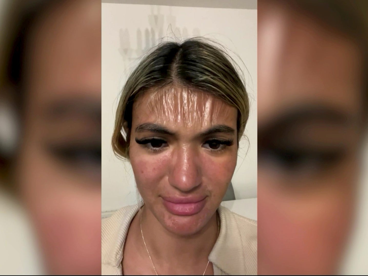 A video grab of Sirin Murad’s sunburnt forehead