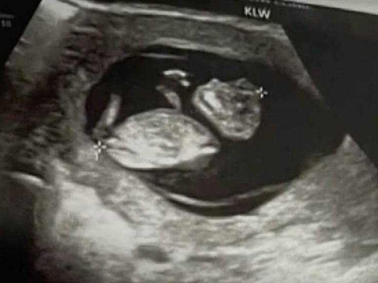 Nancy Davis’s child is seen on an ultrasound which shows its skull underdeveloped